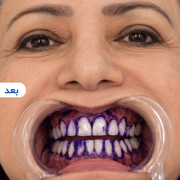 بعد استفاده خمیر دندان بنفش v34